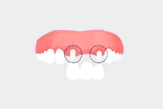 他の歯への影響２