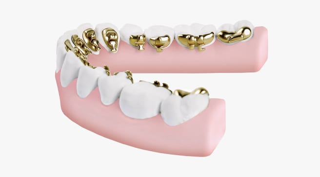 裏側矯正イメージ画像