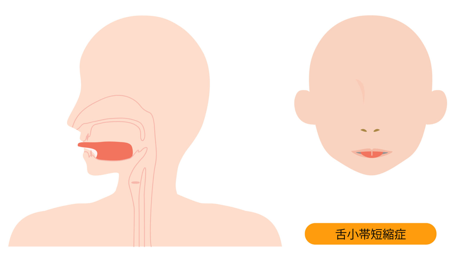 舌小帯短縮症(ハート舌) | 吉祥寺矯正歯科クリニック