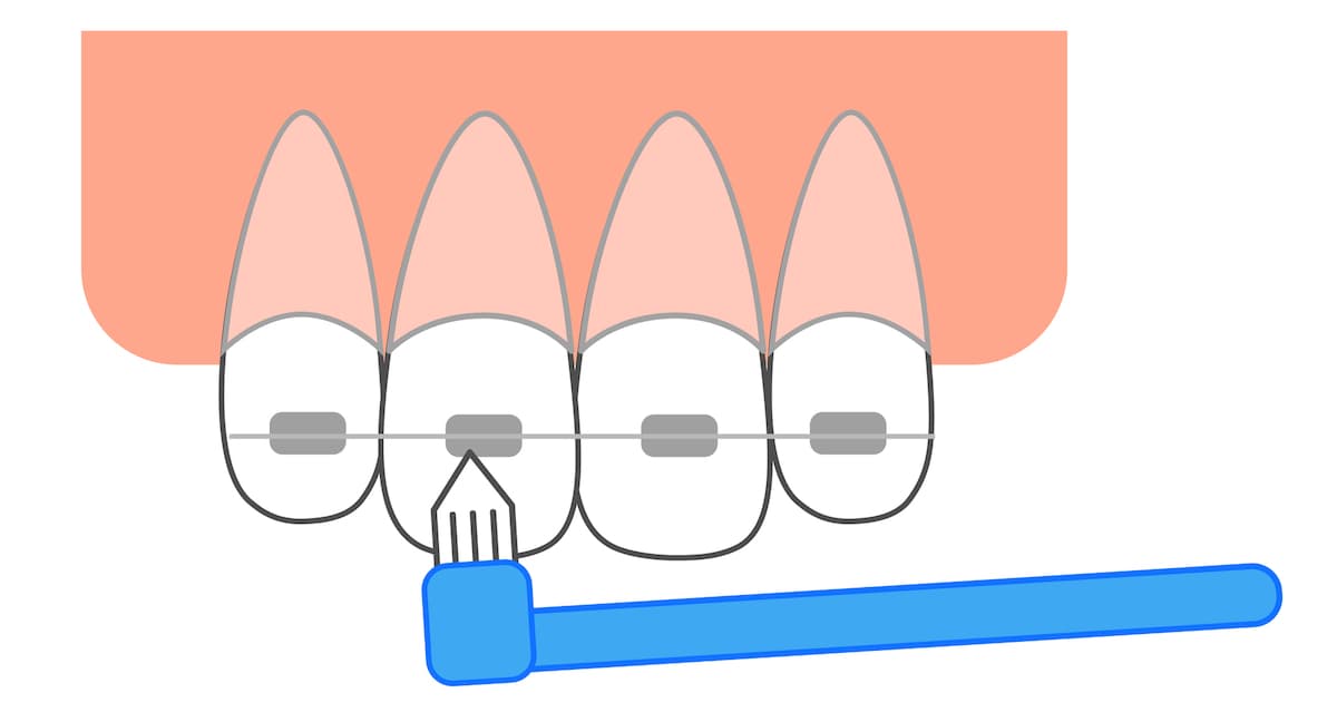 矯正　歯ブラシ