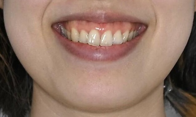 ガミースマイル