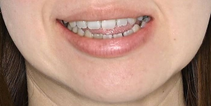 サージェリーファースト（顎）