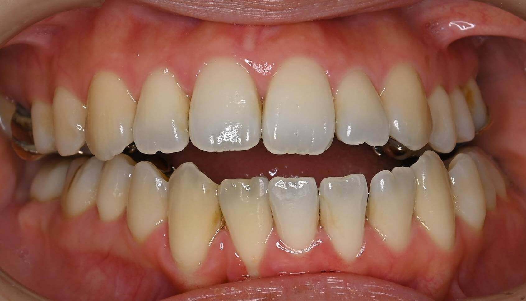 サージェリーファースト（歯）