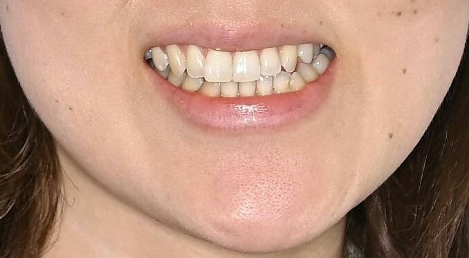 サージェリーファースト（顎）