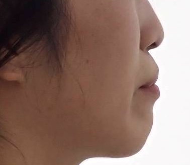 口ゴボの治療について 1