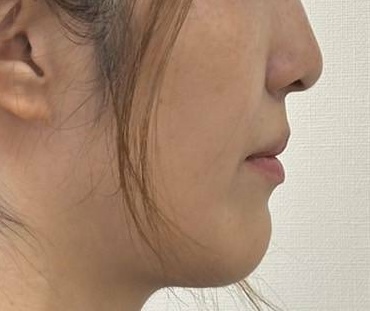 口ゴボの治療について 2